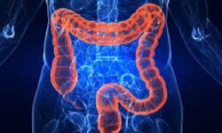 ارتباط مراحل اولیه بیماری التهابی روده با تغییرات در باکتریهای روده